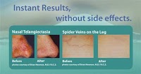 Red Vein Removal Bournemouth 379842 Image 1